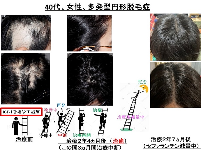 円形脱毛症　病院